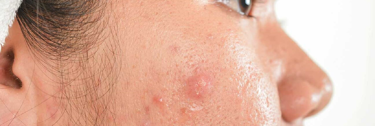 como funciona a medicação contra acne