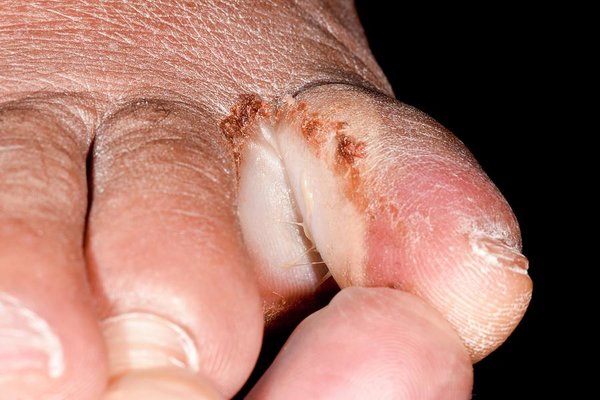 O que é o abscesso do dedo do pé