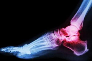 artrite da articulação do tornozelo
