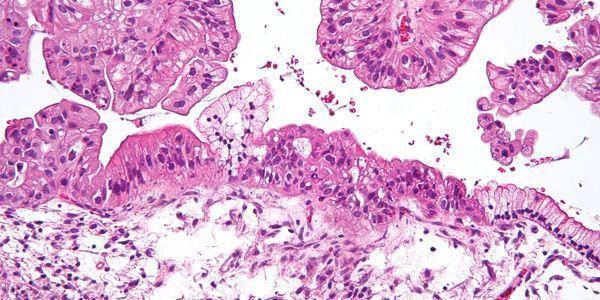 cystadenoma mucinoso benigno de ovário