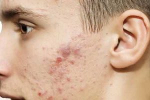 tratamento homeopático para acne