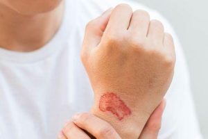 doença de pele relacionada com o trabalho ou doença de pele ocupacional
