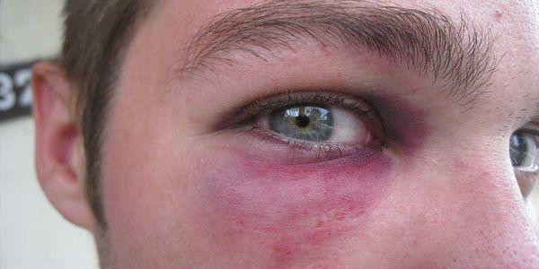 o que pode causar fratura do olho ou fratura do soquete ocular e como ele é tratado